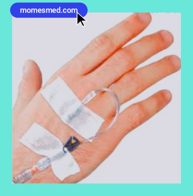 فیکس انژیوکت با چسب حصیری